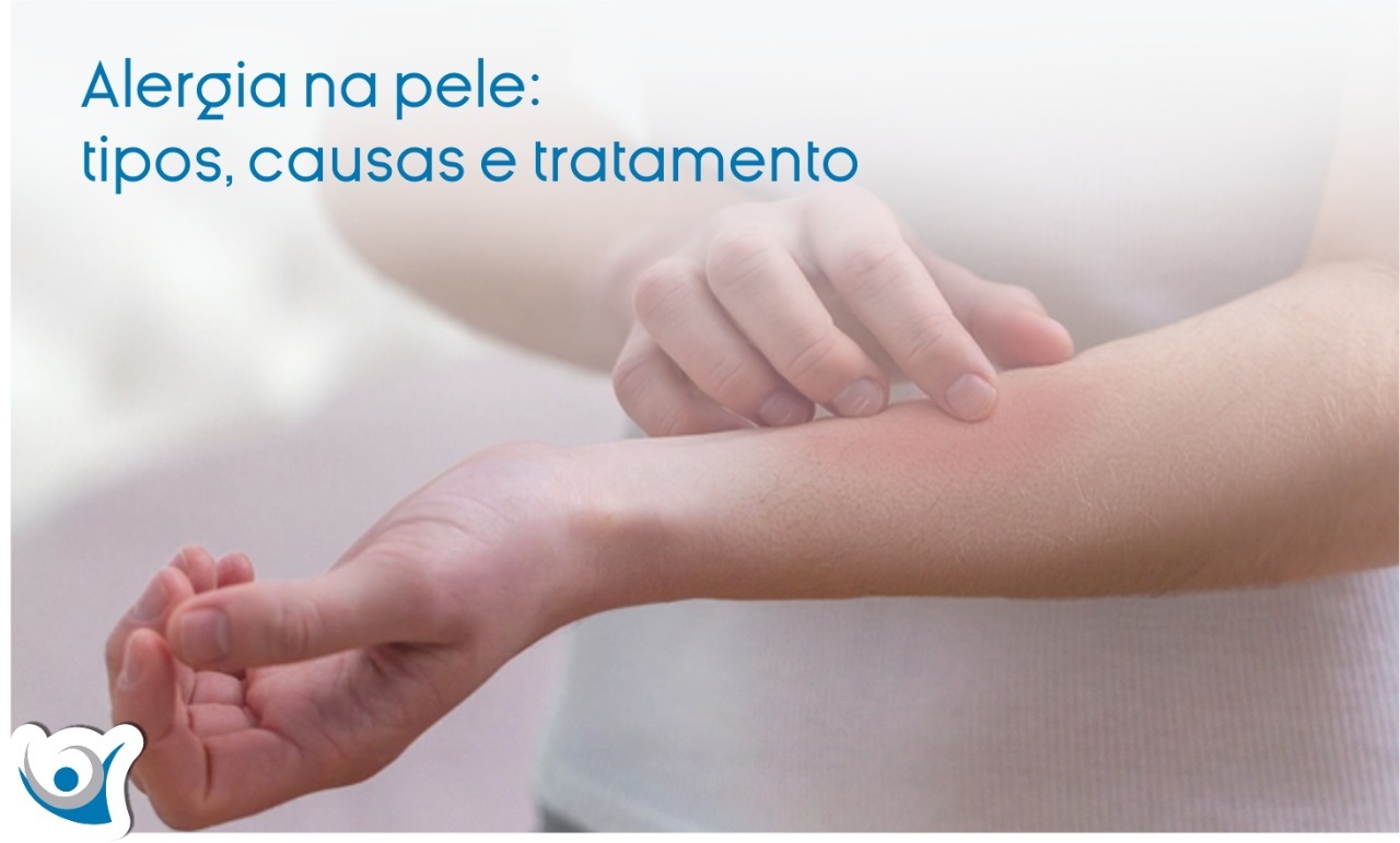 10 Alergia Emocional Na Mão Sintomas