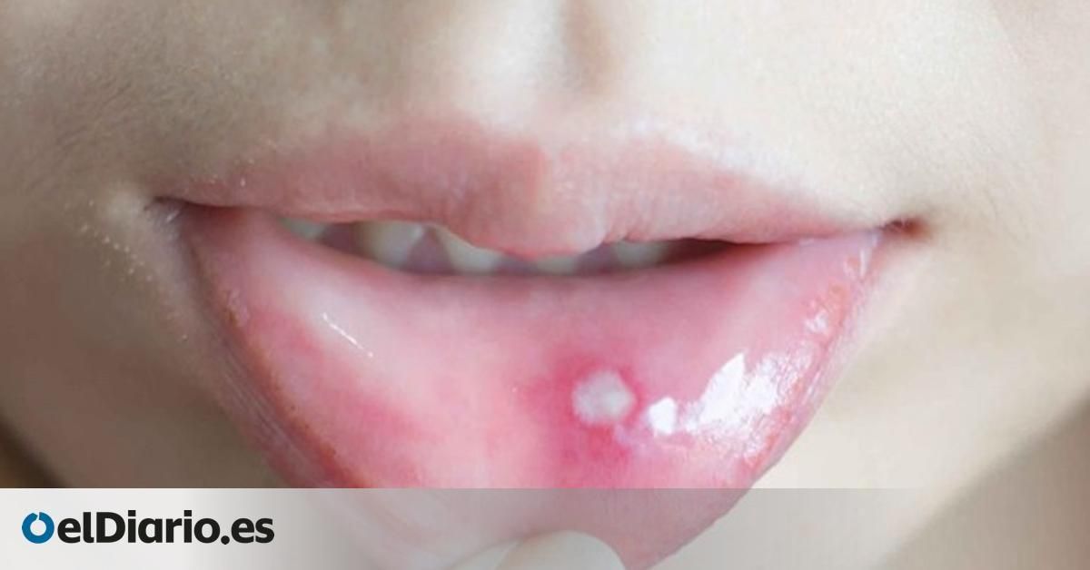 10 Ampollas En La Lengua Remedios Naturales