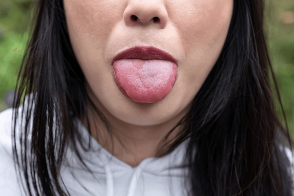 10 Angioedema Tongue Pictures For Easy Diagnosis