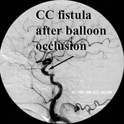 10 Balloon Occlusion Tests For Safe Procedures