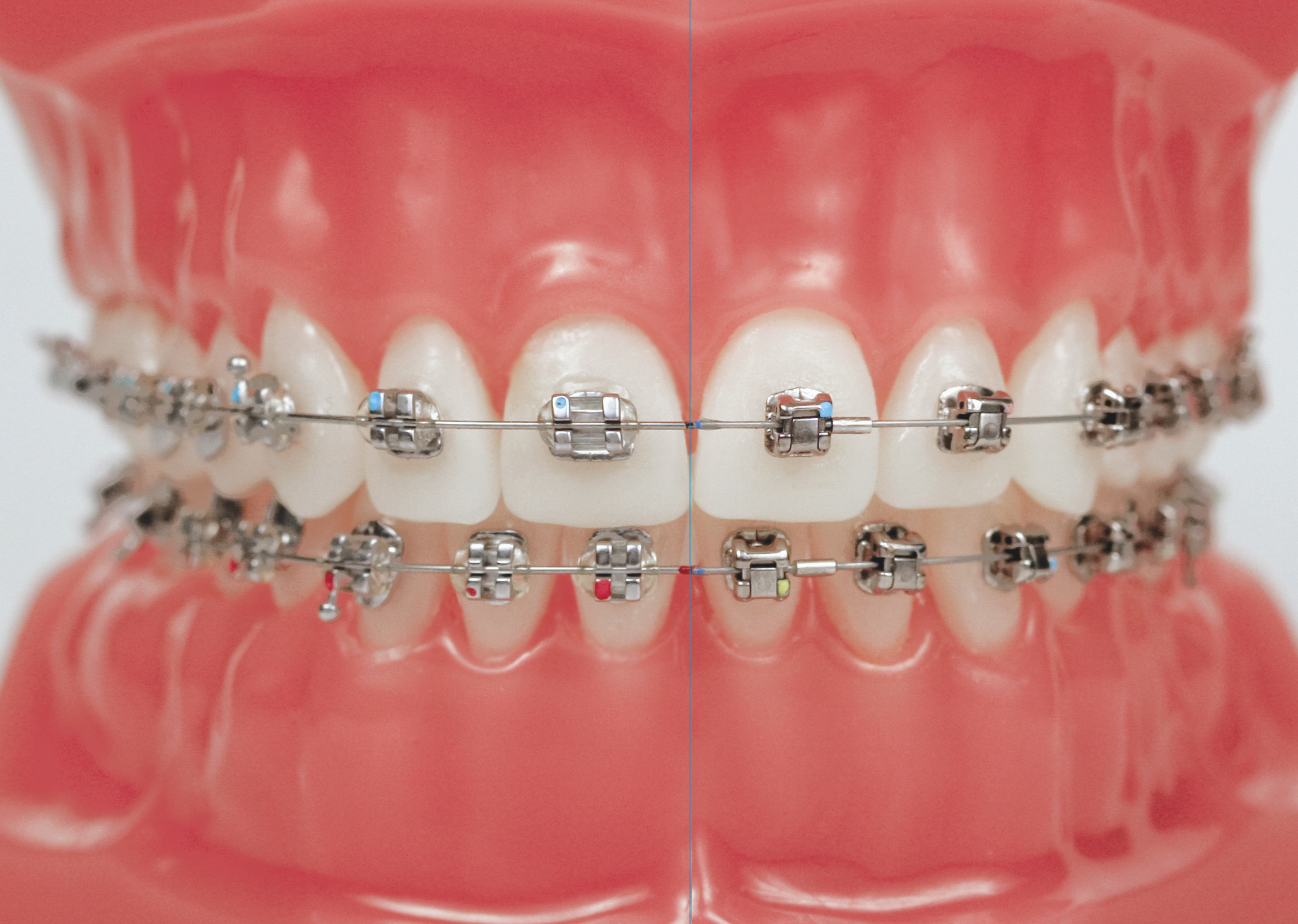 10 Braces Cost Savings Tips