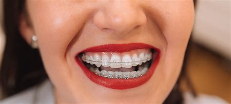 10 Braces Tips For A Perfect Smile 10 Braces Tips For A Perfect Smile