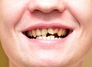 10 Broken Tooth Wax Tips For Quick Relief