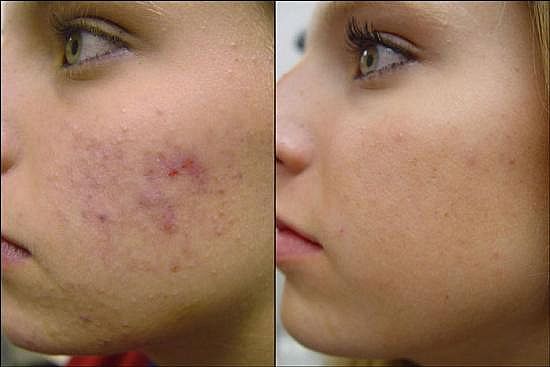 10 Calcium Marks Removal Tips 10 Calcium Marks Removal Tips