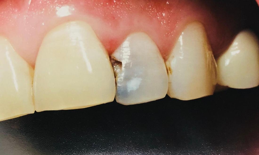 10 Cavity Filled Front Tooth Tips For Perfect Smile
