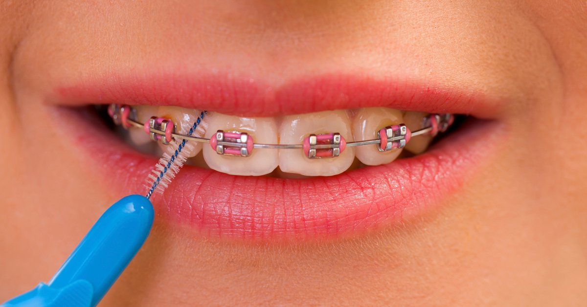 10 Colores Para Brackets Que Mejoran La Legibilidad