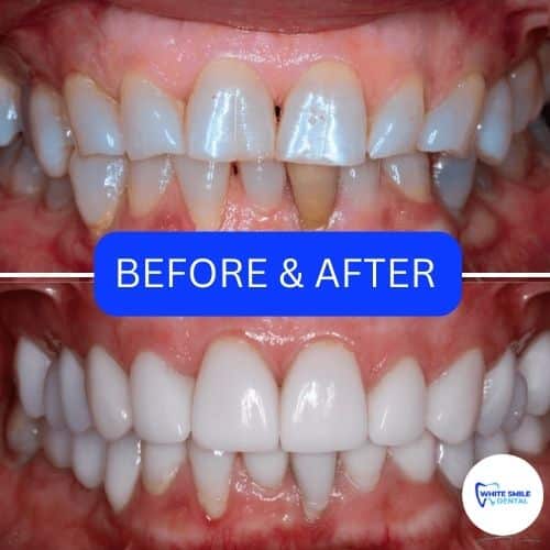 10 Composite Veneers Tips For Perfect Smile