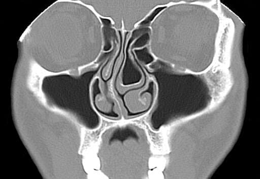 10 Concha Bullosa Fixes For Easier Breathing