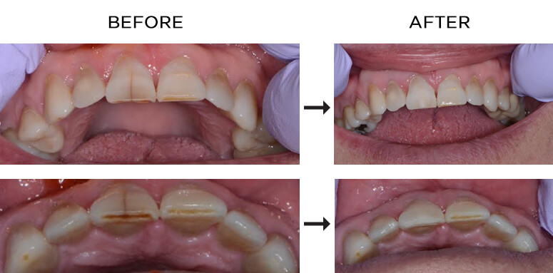 10 Craze Lines Remedies For Healthier Smile