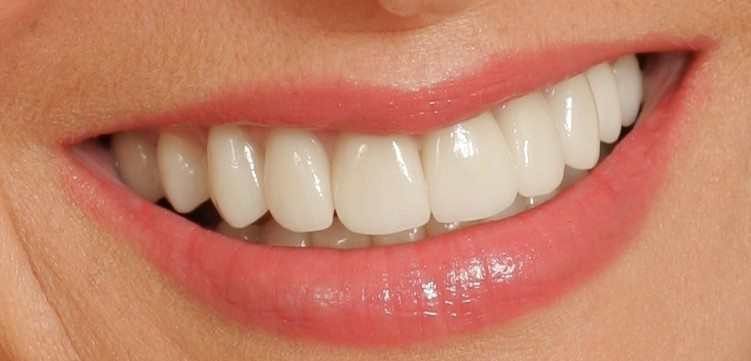 10 Crown Front Teeth Fixes For Perfect Smile