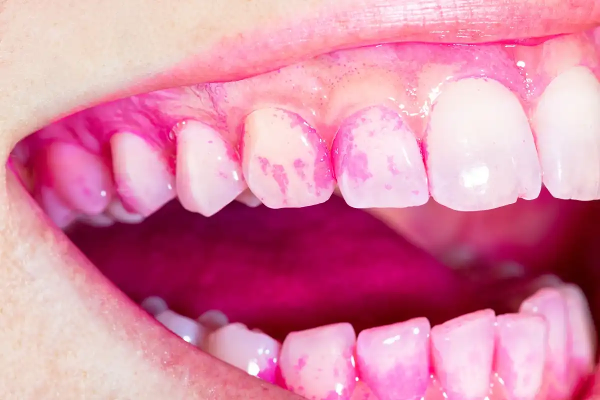 10 Disclosure Dental Tablets For Cleaner Teeth