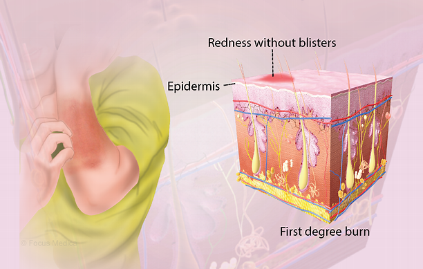 10 First Degree Burn Images To Identify Symptoms 10 First Degree Burn Images To Identify Symptoms