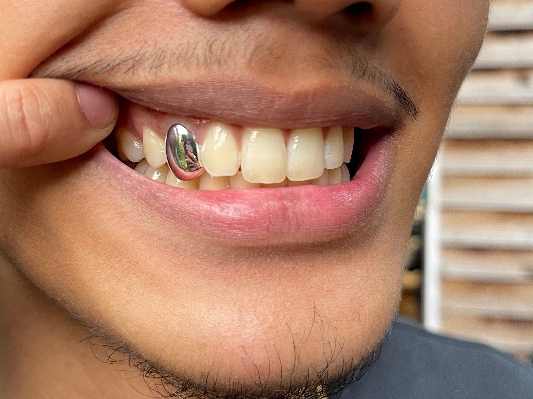 10+ Front Tooth Cap Remedies For Smile Confidence