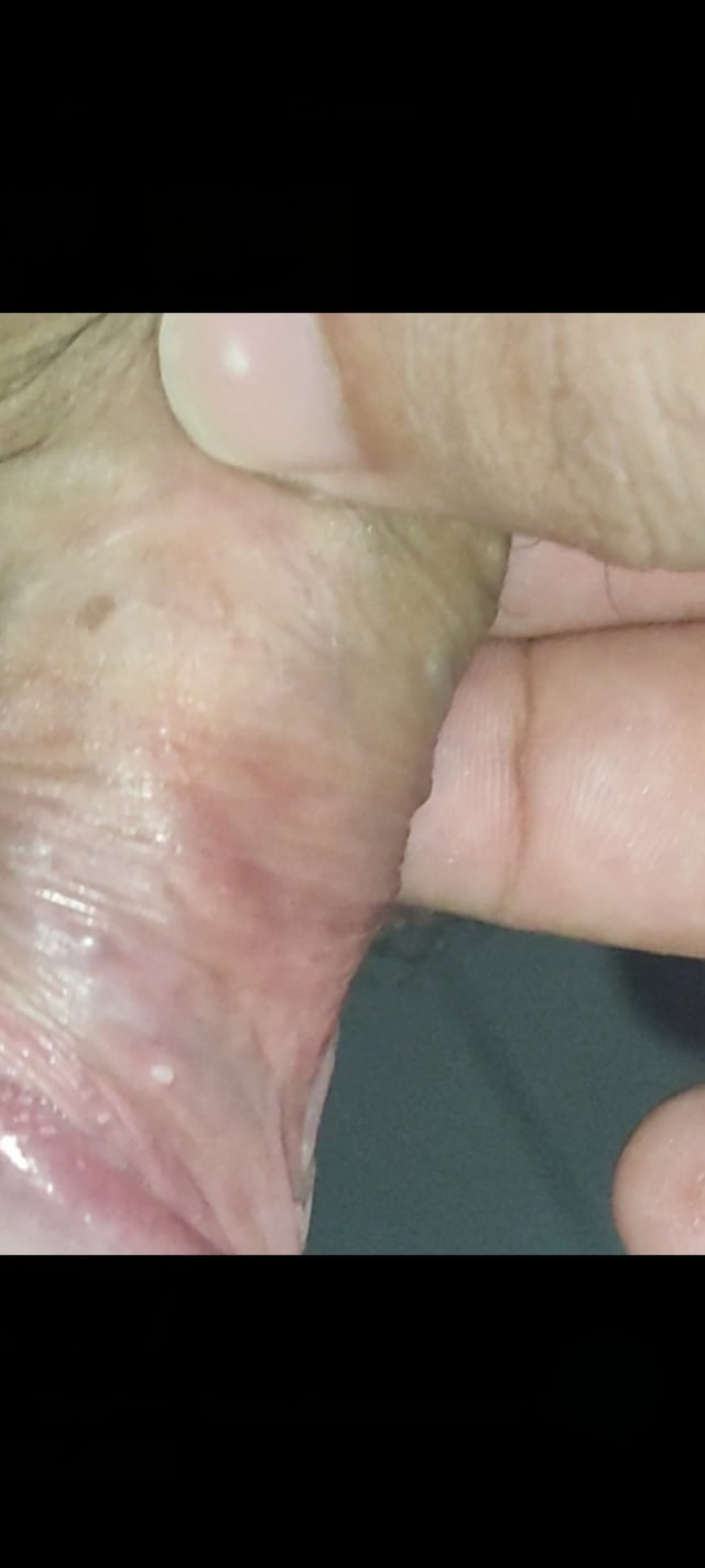 10 Grano En El Pene Remedios Naturales