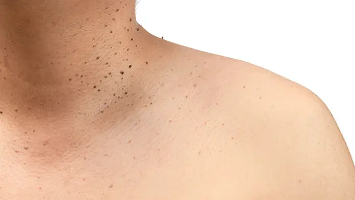 10+ Gum Disease Secrets To Remove Black Spots