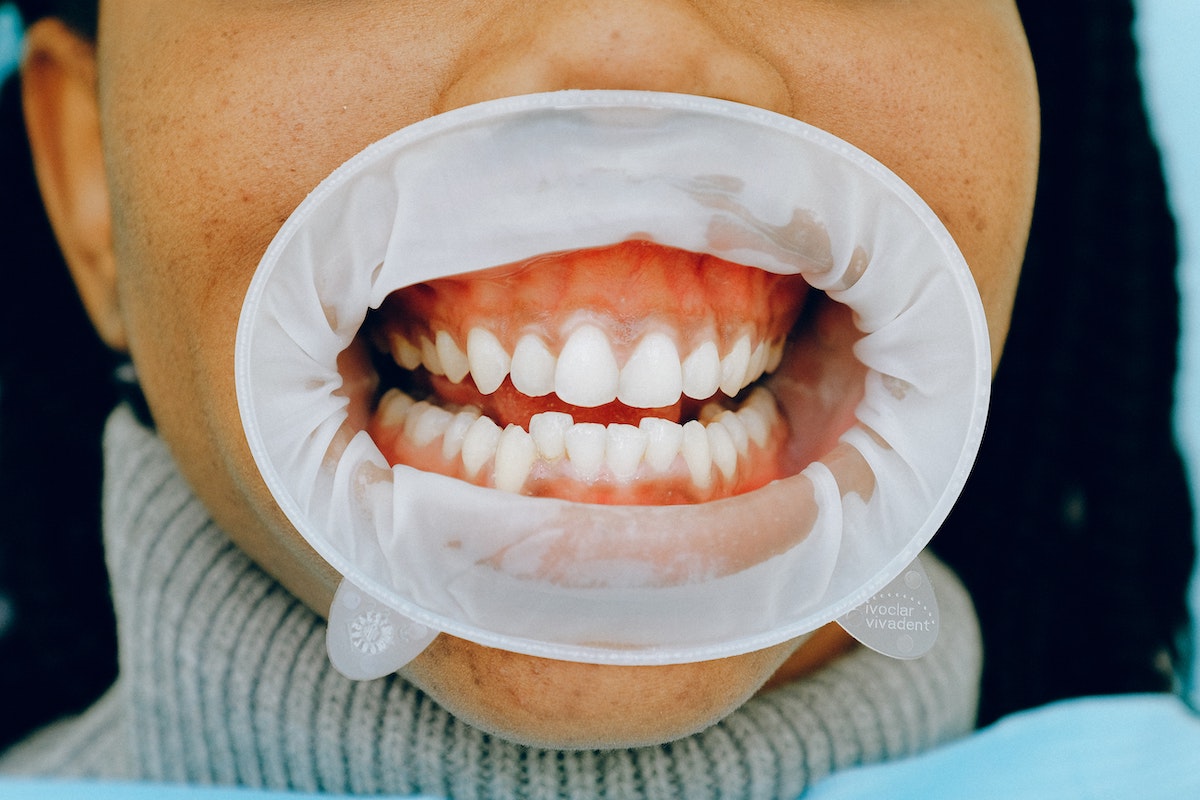 10 Gums Bleed Fixes For Healthier Teeth