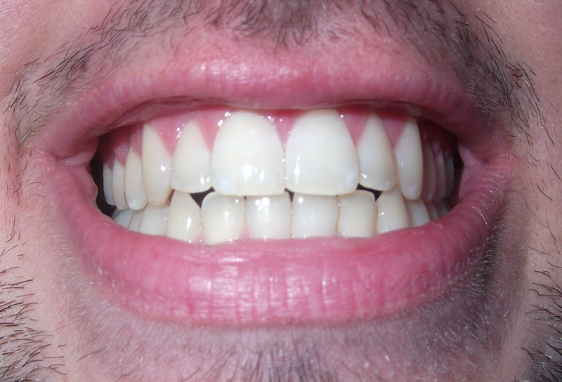 10 Gums Feeling Itchy Remedies For Fast Relief