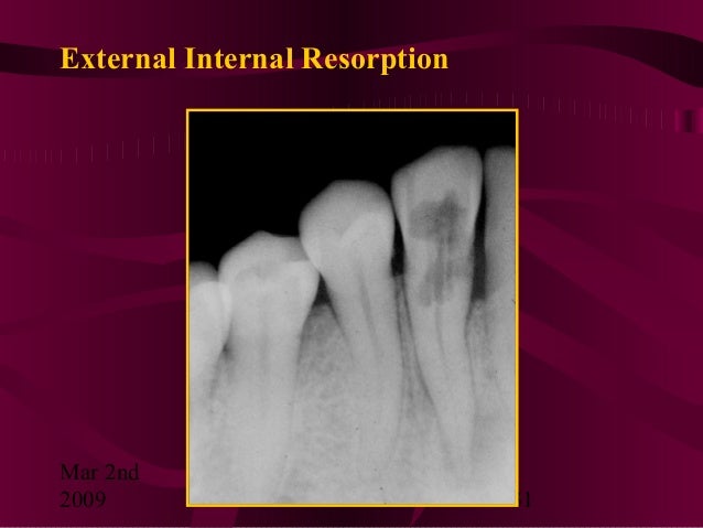 10+ Internal Resorption Solutions Save Teeth