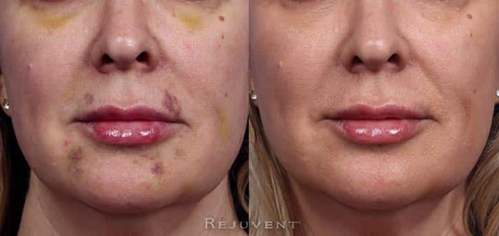 10 Lip Bruising Remedies For Faster Healing