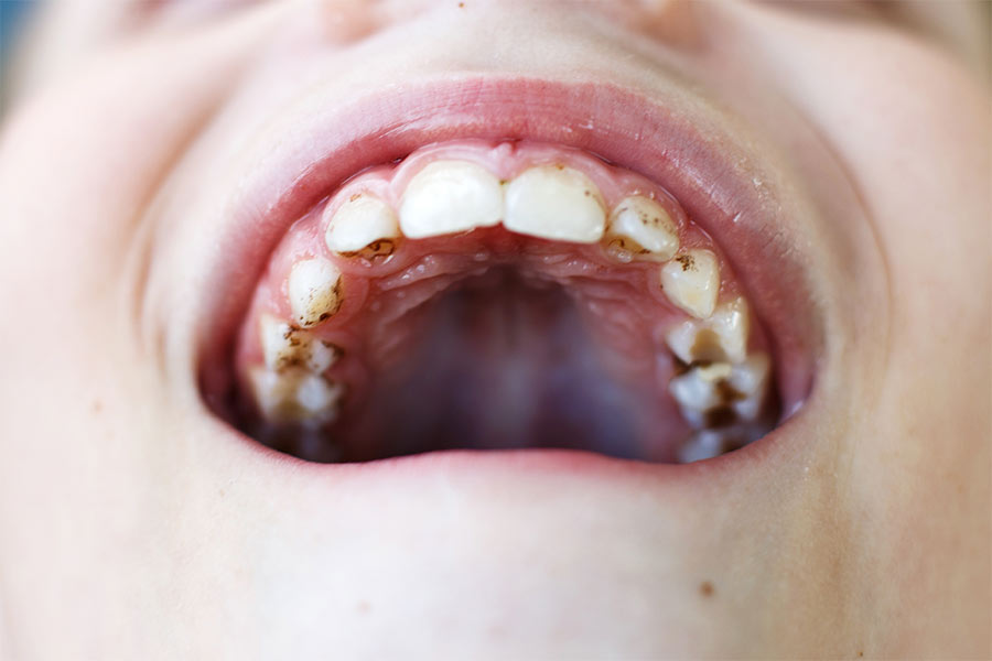 10 Manchas Negras En Los Dientes Remedios Naturales 10 Manchas Negras En Los Dientes Remedios Naturales