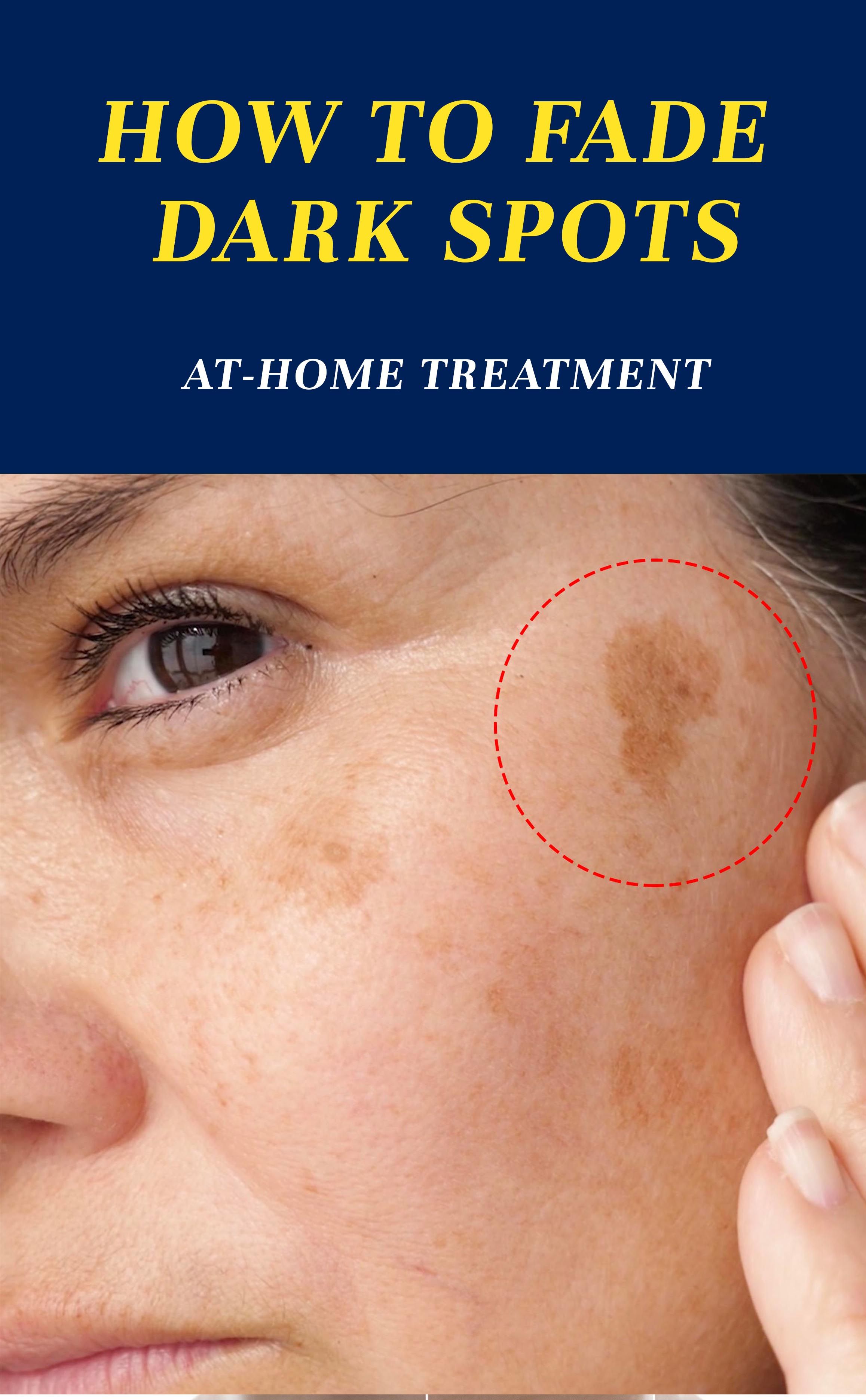 10 Mederma Tips To Fade Dark Spots