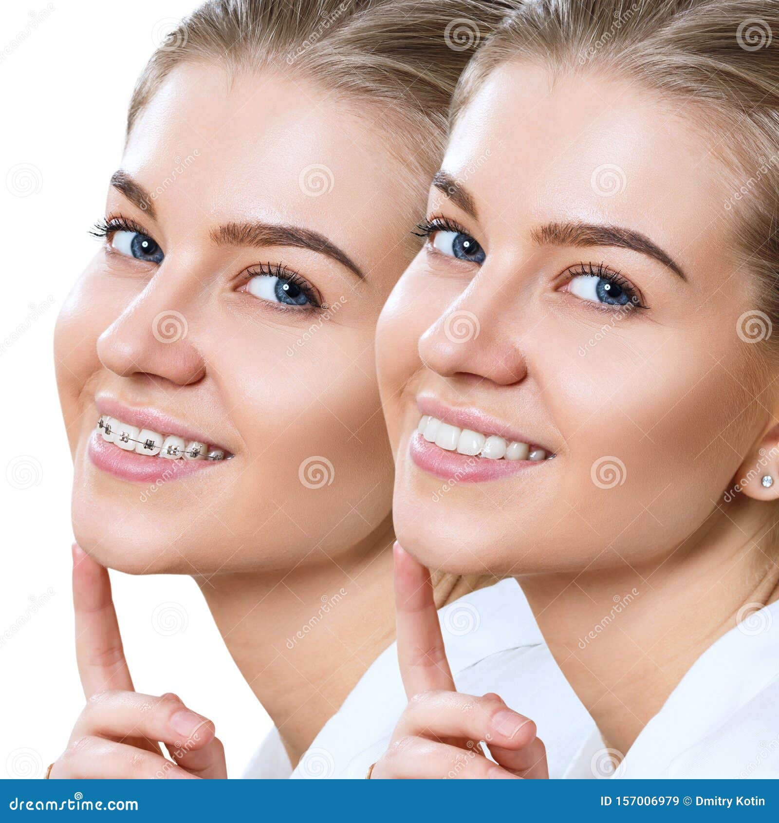 10 Metal Teeth Braces Tips For Perfect Smile 10 Metal Teeth Braces Tips For Perfect Smile