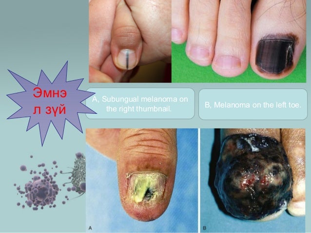 10+ Nail Tumor Treatments For Faster Recovery