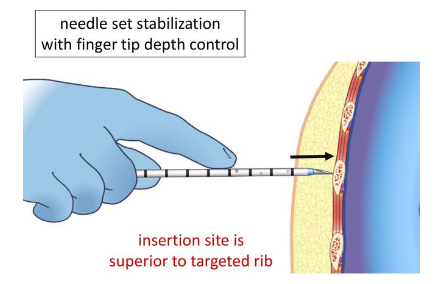 10+ Needle Chest Decompression Secrets For Improved Survival