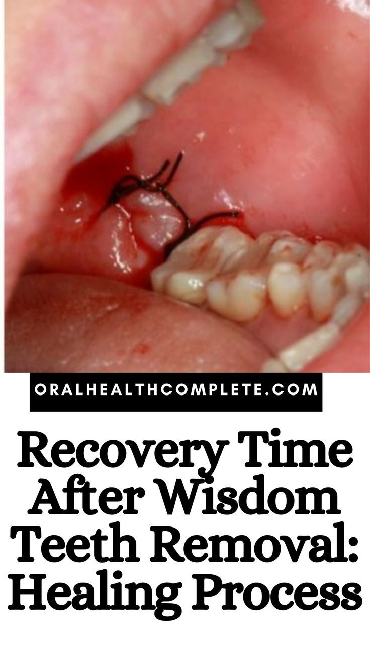 10 Oral Sedation Tips For Wisdom Teeth Removal
