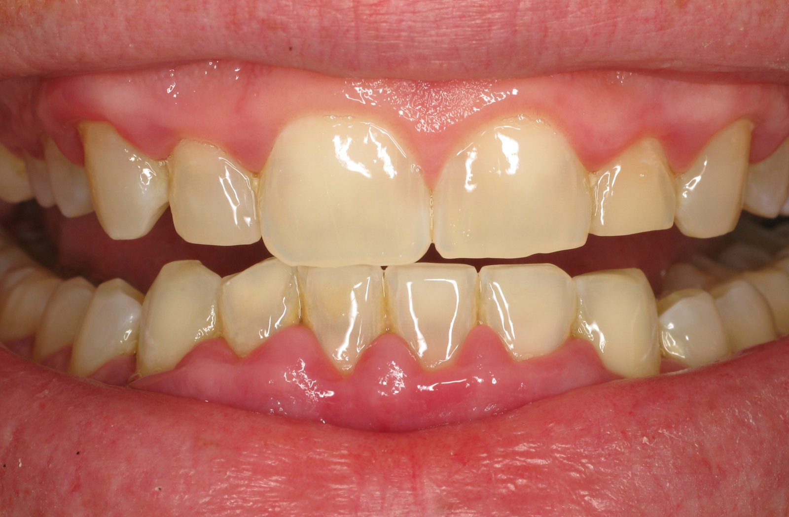 10 Pinhole Gum Procedure Tips For Fast Healing