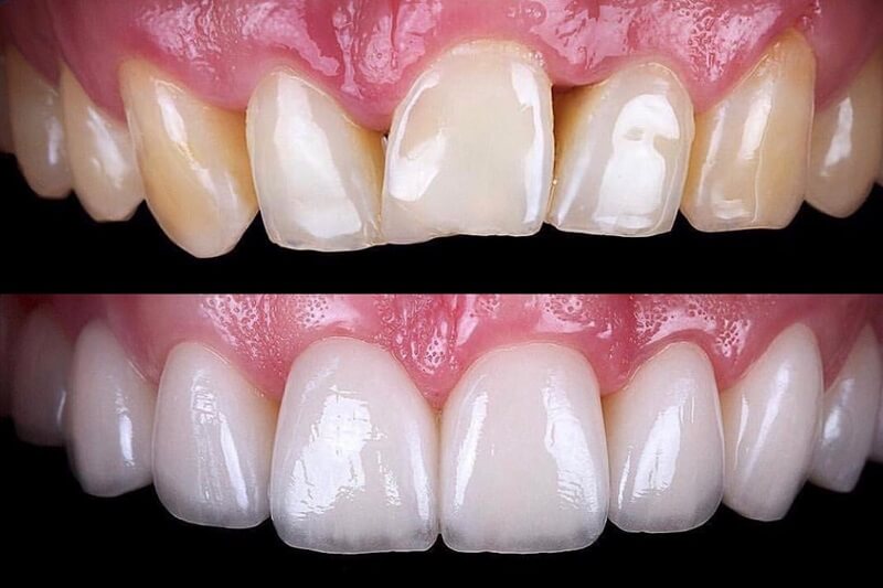 10 Porcelain Teeth Near Me Options For Perfect Smile