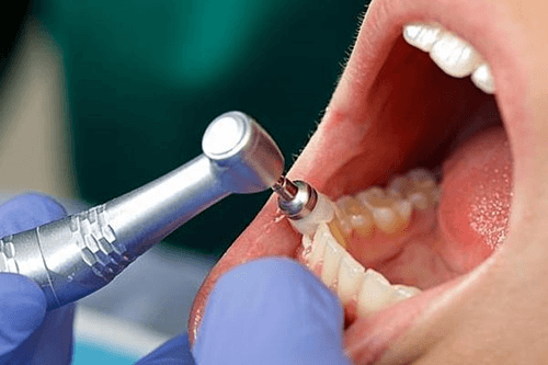 10 Prophylaxis Dentist Tips For Cleaner Teeth