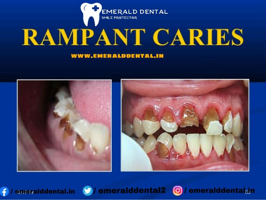 10+ Rampant Dental Caries Solutions To Save Teeth