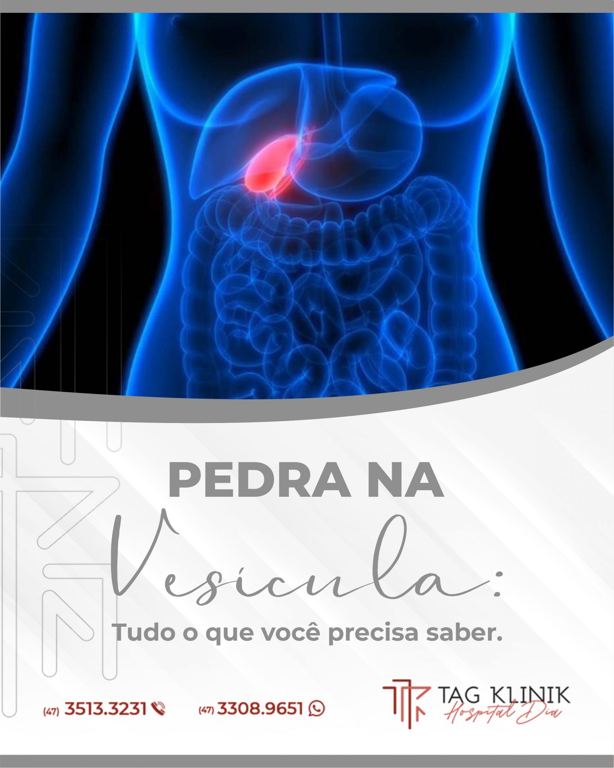 10+ Sintomas De Vesícula Pedra Revealed