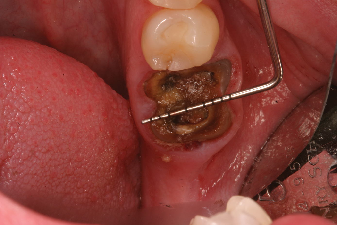 10 Smoking Tips After Molar Extraction