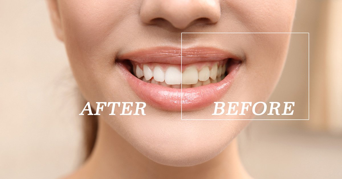 10 Teeth Whitening Remedies To Fix Discoloration