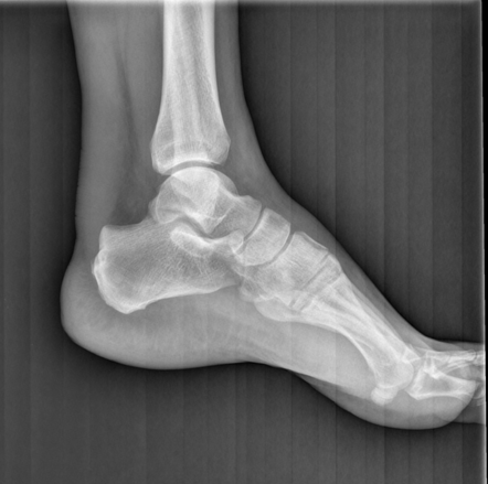 10+ Tendon Xanthoma Pictures To Identify Symptoms 10+ Tendon Xanthoma Pictures To Identify Symptoms