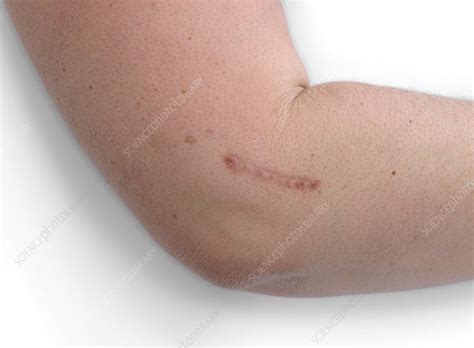 10 Tennis Elbow Surgery Scars That Fade Fast