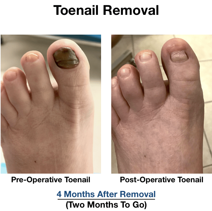 10+ Toenail Removal Secrets For Permanent Fix