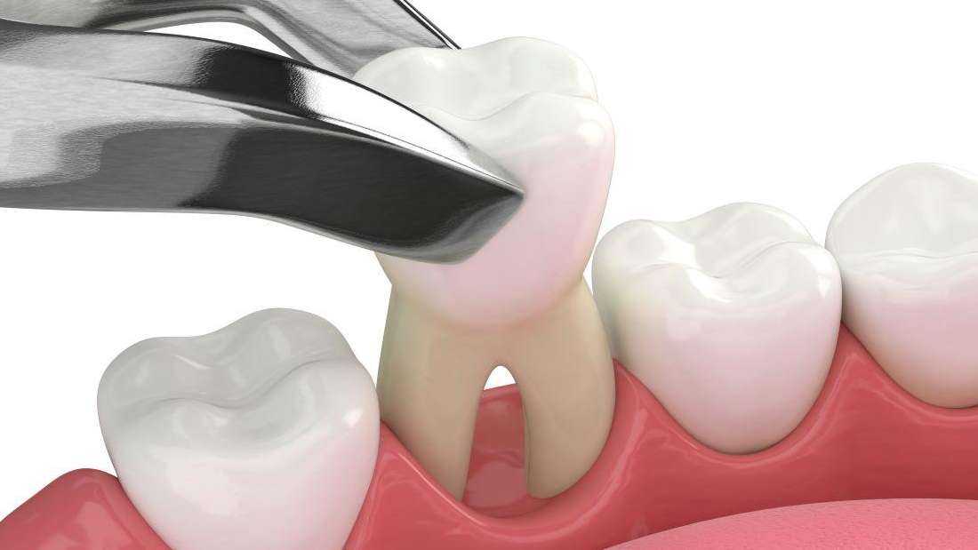 10 Tooth Extraction Blood Clot Tips For Faster Healing