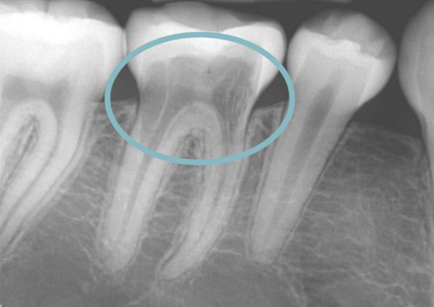 10+ Tooth Resorption Symptoms To Know