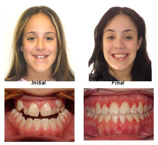 10 Underbite Classes To Improve Smile