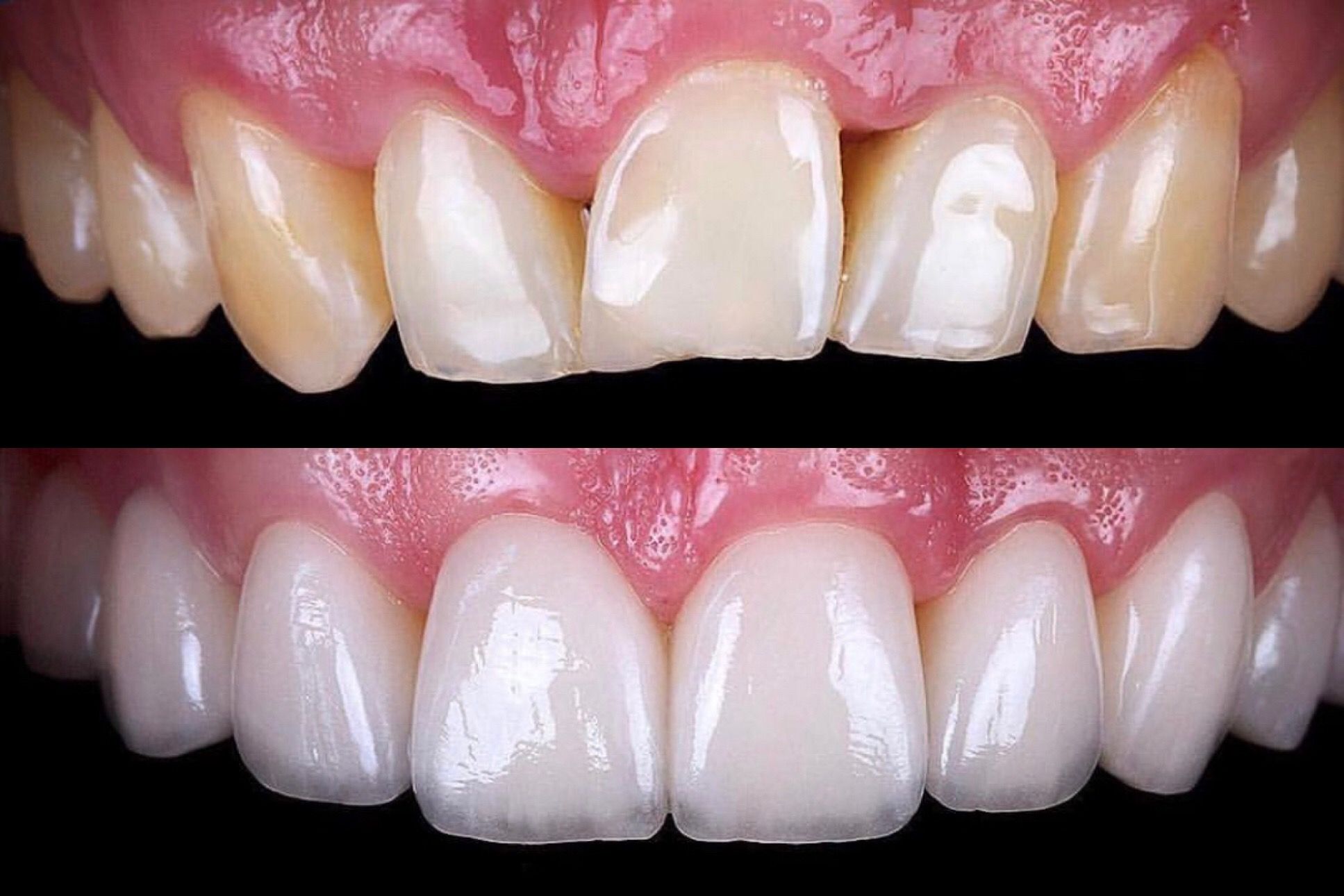 10 Veneers Near Me Options For Perfect Smile