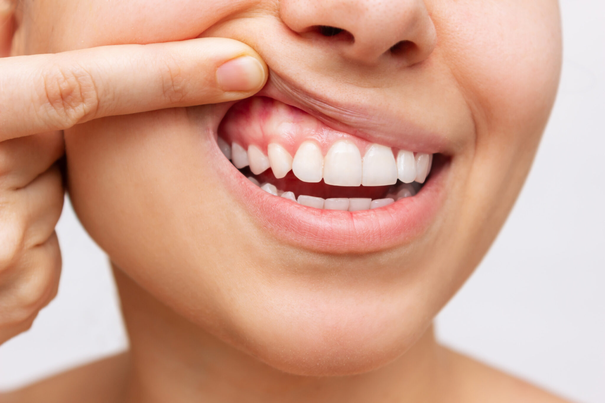 10+ White Gums Remedies For Healthier Smile