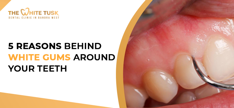 10 White Gums Solutions That Work