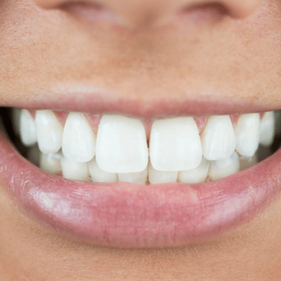 10 Yellow Teeth Fixes For Healthier Smiles
