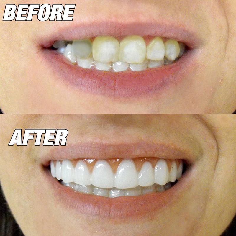 11 Bridge Teeth Fixes For Perfect Smile