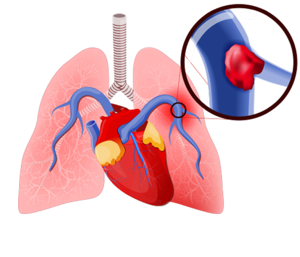 12+ Air Embolism Prevention Secrets For Divers