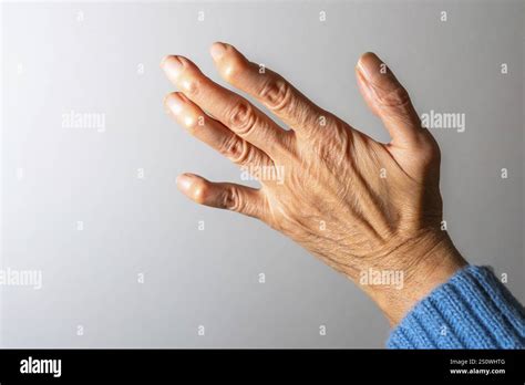 12 Arthritis Hand Photos Revealing Hidden Signs