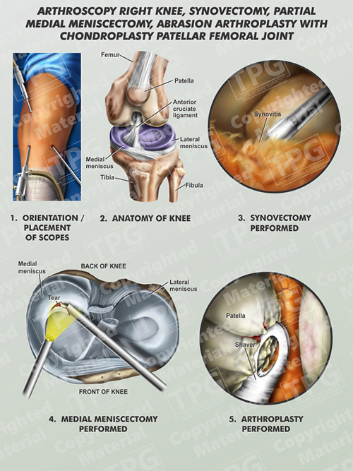 12+ Arthroscopy Tips To Prevent Foot Numbness